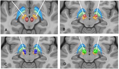 New Onset On-Medication Freezing of Gait After STN-DBS in Parkinson's Disease